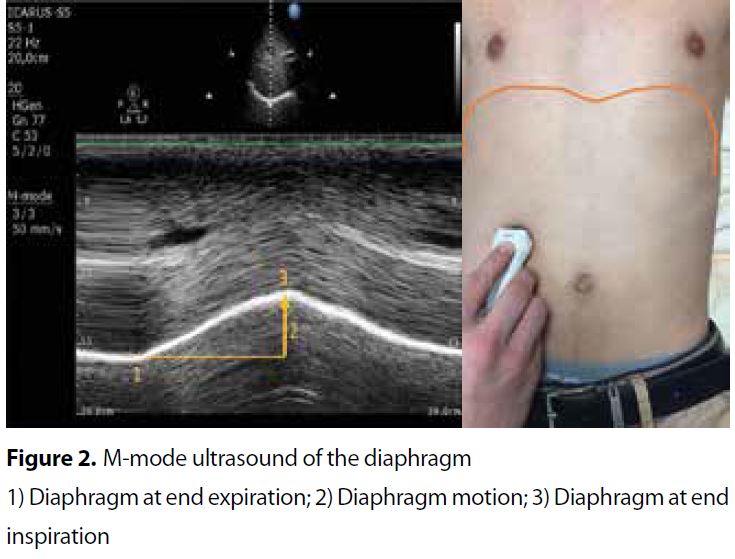 M-mode sonography of diaphragmatic motion: description of